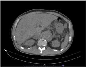 abdominal-ct-scan