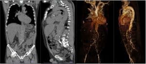 abdominal-CT-scan-and-CT-aortogram
