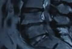 MRI shows modic change before (a,b) and after (c,d) PRP injection