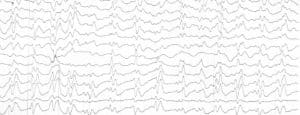 EEG showing periodic sharp wave complexes