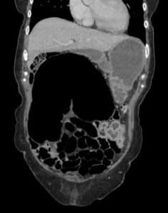 CT images of the abdomen indicative of caecal volvulus