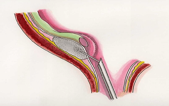 Pediatric Vesico-Ureteral Reflexes: Current Management - medtigo Journal
