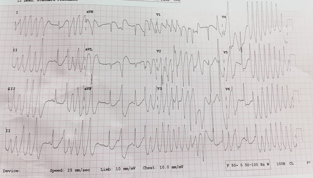 Torsades de Pointes in Respiratory Failure & GTCS: A Case Report ...