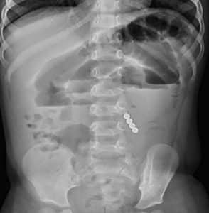 Scout abdominal film showing multiple air fluid levels
