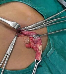 Appendix specimen sent to pathology