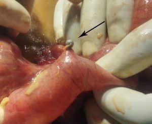 Operative photo showing perforation with magnet in the intestine