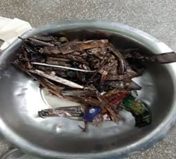 Plastic retrieved from patient’s stomach