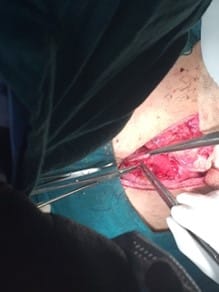Perforation on anterior wall of stomach