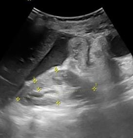 USG showing ascitic free fluid