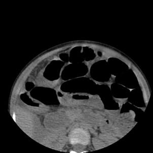 CT image of axial section