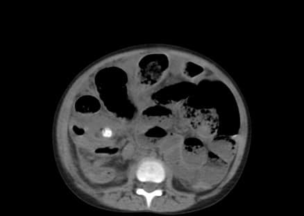 CT image showing radiopaque mass