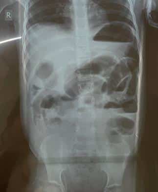 x-ray of abdomen