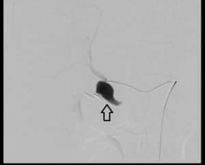 Angiography pre coiling