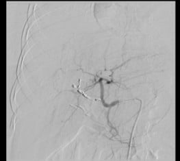 Angiography post coiling