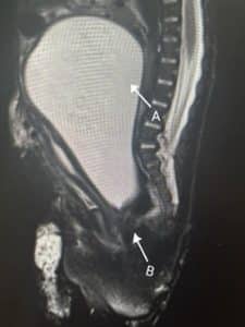 MRI of the baby showing hydrometocolpos