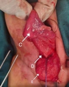 Picture showing collapsed uterus